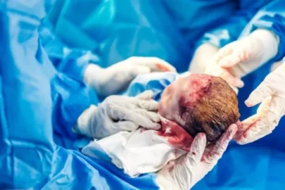 Birth Injury