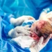 Birth Injury