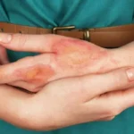 What Is a Burn Injury