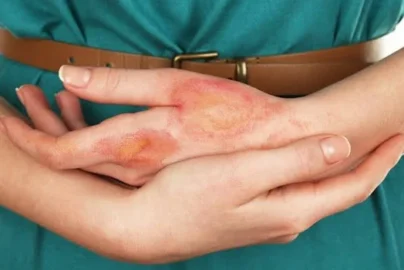 What Is a Burn Injury
