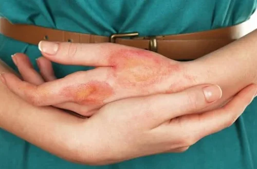 What Is a Burn Injury