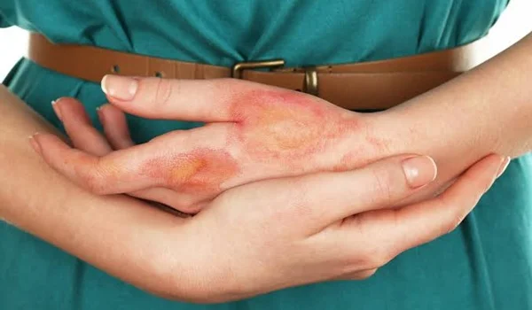 What Is a Burn Injury